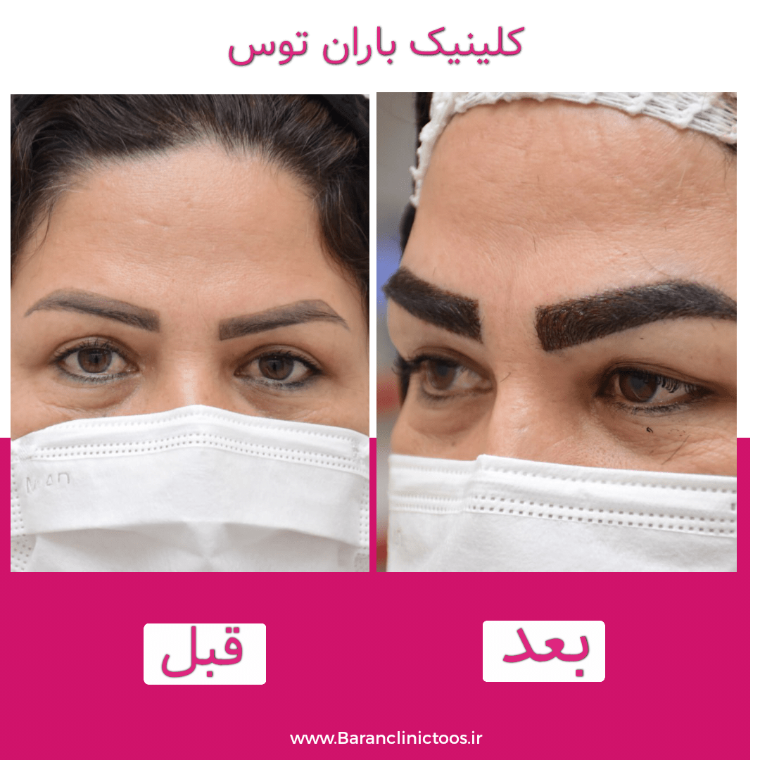 قبل و بعد کاشت ابرو